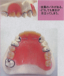 バネ式の入れ歯